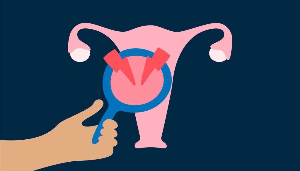 Kinésithérapie et endométriose